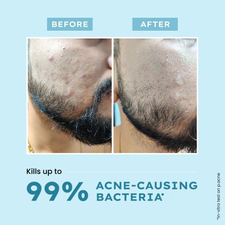 Hyphen%20Clarifying%20Acne%20Face%20Wash%20for%20Women%20and%20Men%20%7C%20Cleanser%20For%20Acne%20Prone%20Skin%20with%20Salicylic%20Acid%202%25,%20Zinc%20PCA,%20Witch%20Hazel%2010%25%20%7C%20Oil%20Control%20Pore%20Cleasning%20%7C%20Antibacterial%20&%20Non-Drying%20-%20100ml%20-%20By%20Allure%20Cosmetics%20-%20Image%208