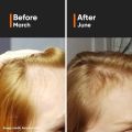 Minimalist Hair Growth Serum With 3% Redensyl, 3% Anagain, 3% Procapil, 5% Capixyl & 4% Baicapil 18% Hair Growth Actives | For Hair Fall Control | For Men & Women | 30 ml. 
