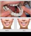 Snap On Veneers Teeth for Men and Women - Moldable False Teeth and Dentures Replacement Kit for Missing Teeth, with Teeth Grinding Guard, Best Whitening Strips and Fake Braces for Bad Teeth. 