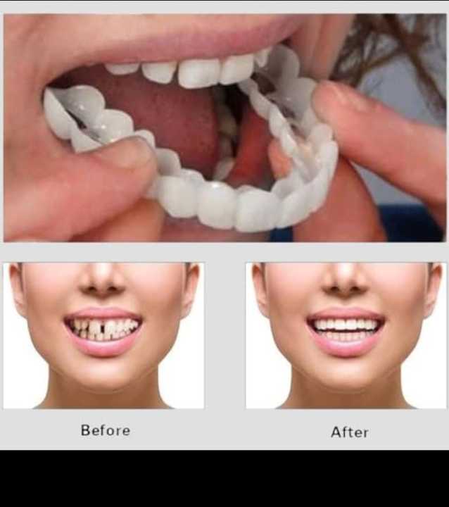 Snap On Veneers Teeth for Men and Women - Moldable False Teeth and Dentures Replacement Kit for Missing Teeth, with Teeth Grinding Guard, Best Whitening Strips and Fake Braces for Bad Teeth