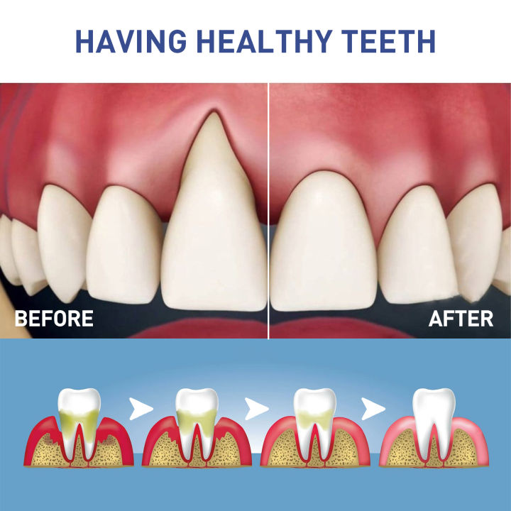 Damaged%20Gum%20Repair%20Care%20Gel%20Relieve%20Sore%20Gums%20Allergy%20Deep%20Cleaning%20Teeth%20Stains%20Tartar%20Serum%20Dental%20Caries%20Tootaste%204ml%20-%20Image%204