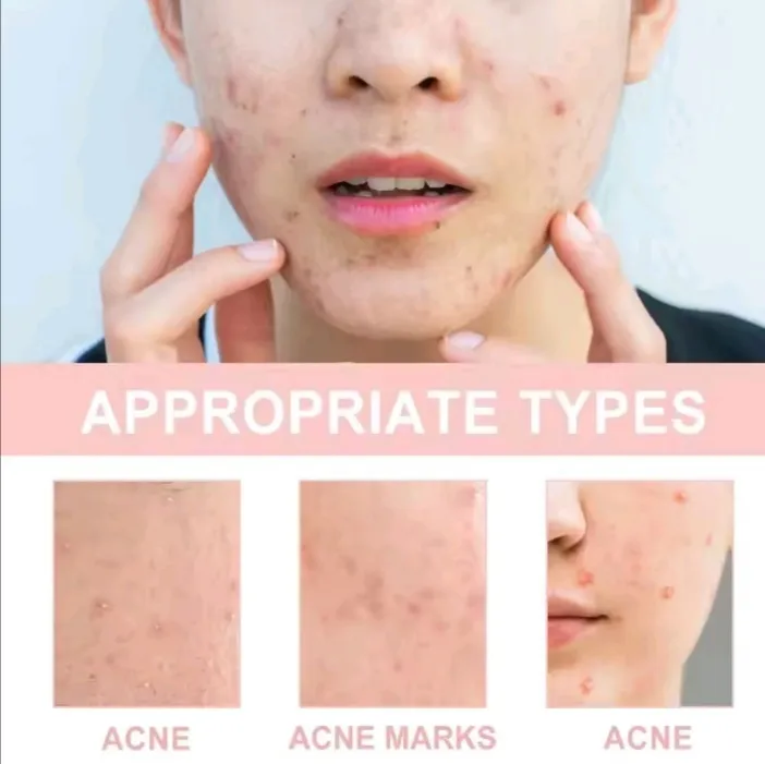 Pimple%20patch%20120pcs%20pimple%20patch%20high%20quality%20effective%20Acne%20patch%20cover%20-%20Image%206