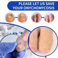 Nail Fungus Patch Waterproof Nail Repair Patch Ingrown Correction Sticker Damaged Nail Gray Care Patch Feet Care Tools. 