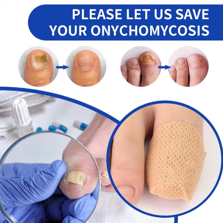 Nail%20Fungus%20Patch%20Waterproof%20Nail%20Repair%20Patch%20Ingrown%20Correction%20Sticker%20Damaged%20Nail%20Gray%20Care%20Patch%20Feet%20Care%20Tools%20-%20Image%204