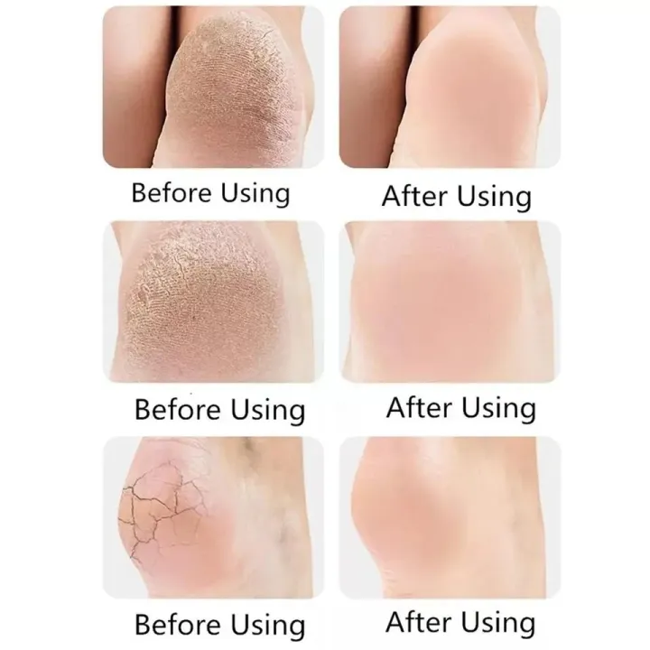 1%20Pair%20(2%20Pcs)%20Pain%20Unisex%20Anti%20Half%20Heel%20Crack%20Protector%20set,%20Half%20Heel%20Pad,%20Moisturizing%20Silicone%20Gel%20Heel%20Socks,%20(Homeducts)%20-%20Image%203