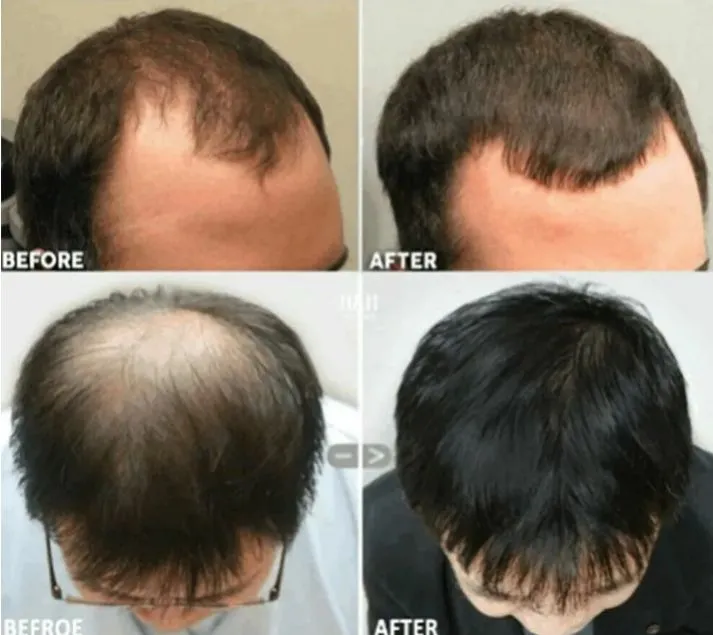 Original%20Derma%20Roller%200.5mm%20For%20Hair%20Regrowth%20Derma%20Roller%200.5mm%20with%20540%20Micro%20Needle%20For%20Hair%20And%20Skin%20Treatment%20Original%20Derma%20Roller%200.5mm%20For%20Bread%20Growth%20Derma%20Roller%200.5mm%20With%20Micro%20Titanium%20Needle%20Derma%20Roller%20For%20Hair%20And%20Skin.%20-%20Image%206