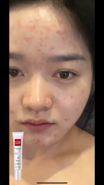 YOUBUY Whitening Freckle Cream Remove Dark Spots Anti Freckle Cream Niacinamide Fade Pigmentation Melasma Brighten