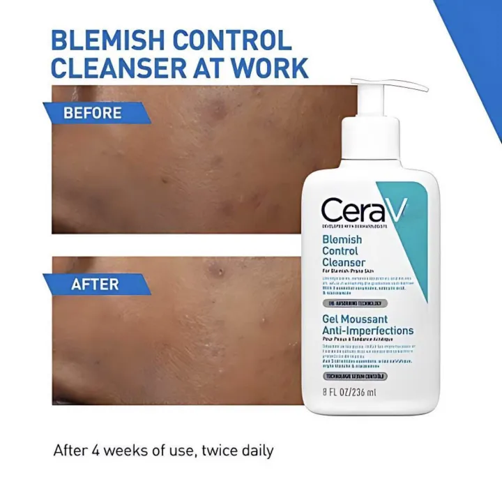 Blemish%20Control%20Cleanser%20%7C%20236ml%20%7C%20Blemish%20Control%20Face%20Wash%20%7C%20Blemish%20Removal%20Cleanser%20%7C%20For%20Blemish%20Prone%20Oily%20Skin%20%7C%20Salicylic%20Acid%20%7C%20Niacinamide%20%7C%20Ceramides%20%7C%20Gentle%20Deep%20Cleansing%20%7C%20Face%20Care%20for%20Clear%20Smooth%20Skin%20-%20Image%208
