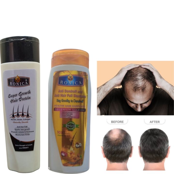 Ronica Hair Shampoo and Tonic work together to fight dandruff, reduce hair fall, and boost hair growth. Enriched with Selenium Sulfide, Keratin, Biotin, and Collagen, they strengthen roots, nourish the scalp, and leave hair shinier, thicker, and healthier