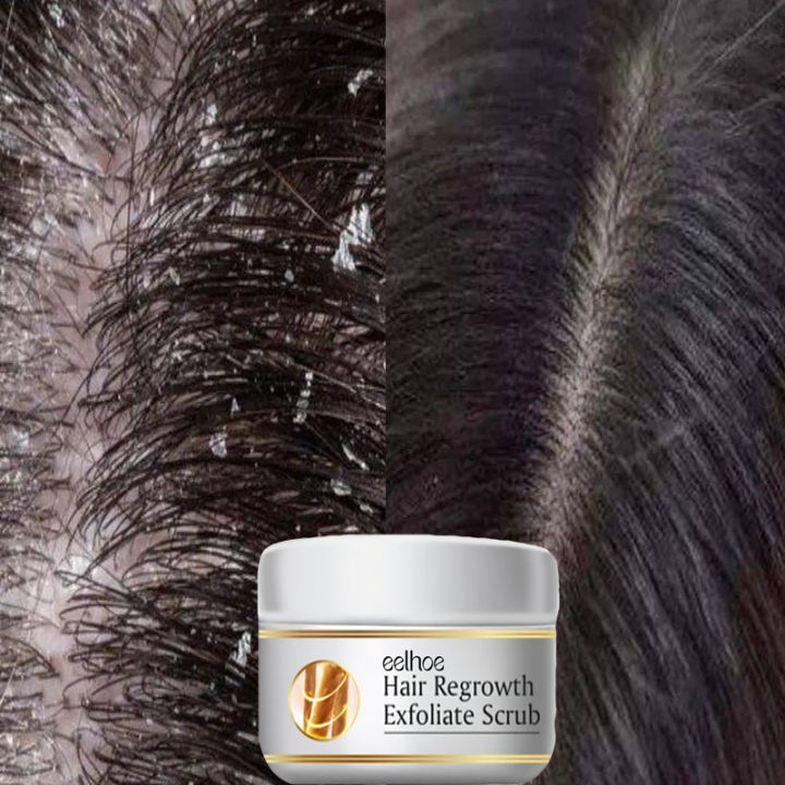 TopZ%20Fast%20Anti%20Dandruff%20Hair%20Oil%20Control%20Treatment%20Relieve%20Itching%20Repair%20Scalp%20Cleaning%20Exfoliating%20Products%20Antipruritic%20Hair%20Care%20Phone%20case%20-%20Image%204