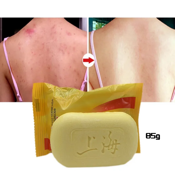 In%20blue%20In%20Sulfur%20Antibacterial%20Cream%20Soap%20Spray%20Set%20Psoriasis%20Eczema%20Anti%20itch%20Relief%20Rash%20Urticaria%20Desquamation%20Ointment%20Body%20Skin%20Care%20phone%20case%20-%20Image%207