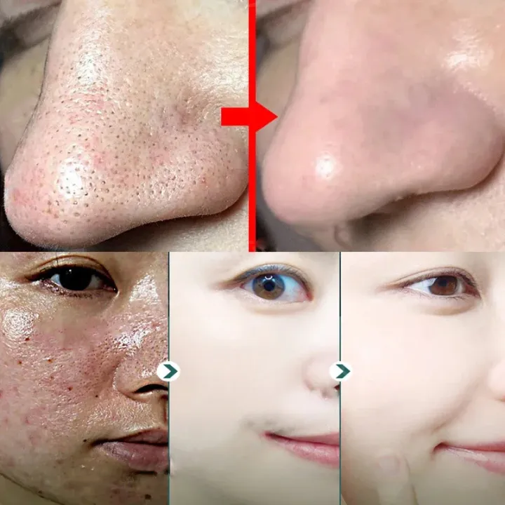 Swanwany%20Salicylic%20Acid%20Pores%20Shrink%20Refining%20Cream%20Repair%20Large%20Open%20Pore%20Remove%20Black%20Dots%20Blackhead%20Acne%20Marks%20Face%20Skin%20Care%20Products%20phone%20case%20-%20Image%203