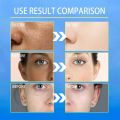 Melasma Remover Cream Removal Dark Pigment Brighten Cream Face Fade Dull Skin Cream Nicotinamide Brightening Moisturize Emulsion. 