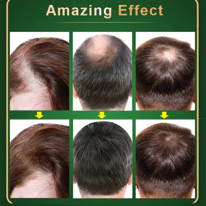 %E3%80%90Best%20Price%20Guaranteed%E3%80%91%20In%20blue%20In%20Thailand%20Neo%20Hair%20Lotion%20Paradise%20120ml%20Hair%20Capillary%20Tonic%20For%20Growth%20Anti%20Hair%20Loss%20Scalp%20Treatments%20Men%20phone%20case+0.5mmroller%20%20color%20is%20random%20-%20Image%2010