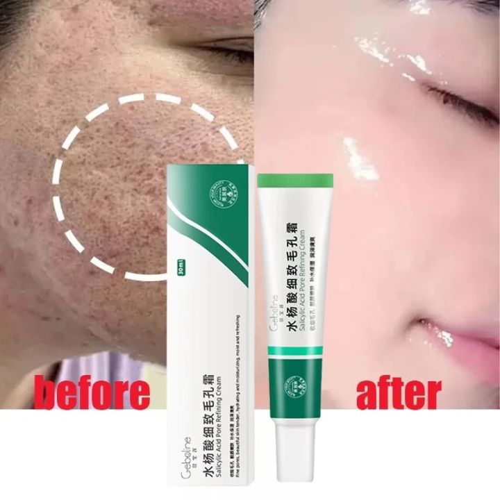 MoupBoi%20Salicylic%20Acid%20Shrink%20Pore%20Cream%20Elimination%20Large%20Pores%20Quick%20Remove%20Blackehead%20Tighten%20Face%20Smooth%20Repairing%20Skin%20Care%20Product%20Phone%20case%20-%20Image%204