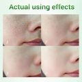 MoupBoi Salicylic Acid Shrink Pore Cream Elimination Large Pores Quick Remove Blackehead Tighten Face Smooth Repairing Skin Care Product Phone case.