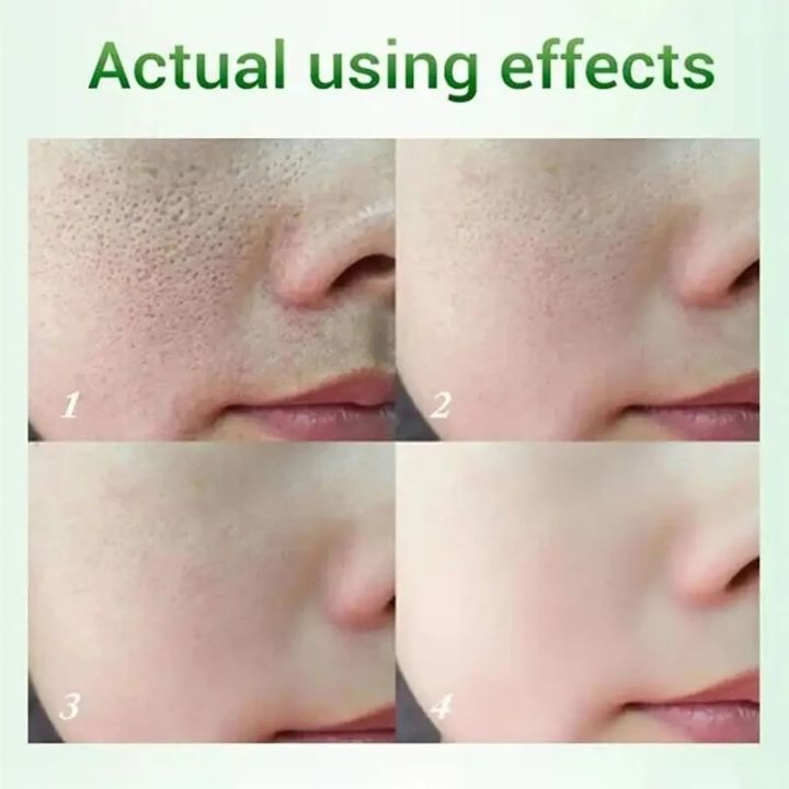 MoupBoi%20Salicylic%20Acid%20Shrink%20Pore%20Cream%20Elimination%20Large%20Pores%20Quick%20Remove%20Blackehead%20Tighten%20Face%20Smooth%20Repairing%20Skin%20Care%20Product%20Phone%20case%20-%20Image%203