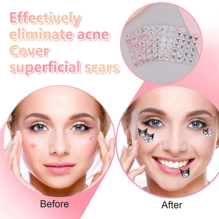 Gesh%20Sanrio%20Hello%20Kitty%20Acne%20Pimple%20Patch%20Sticker%20Acne%20Pimple%20Remover%20Tool%20Blemish%20Spot%20Facial%20Mask%20Skin%20Care%20Cartoon%20Hidden%20Pimple%20phone%20case%20-%20Image%206