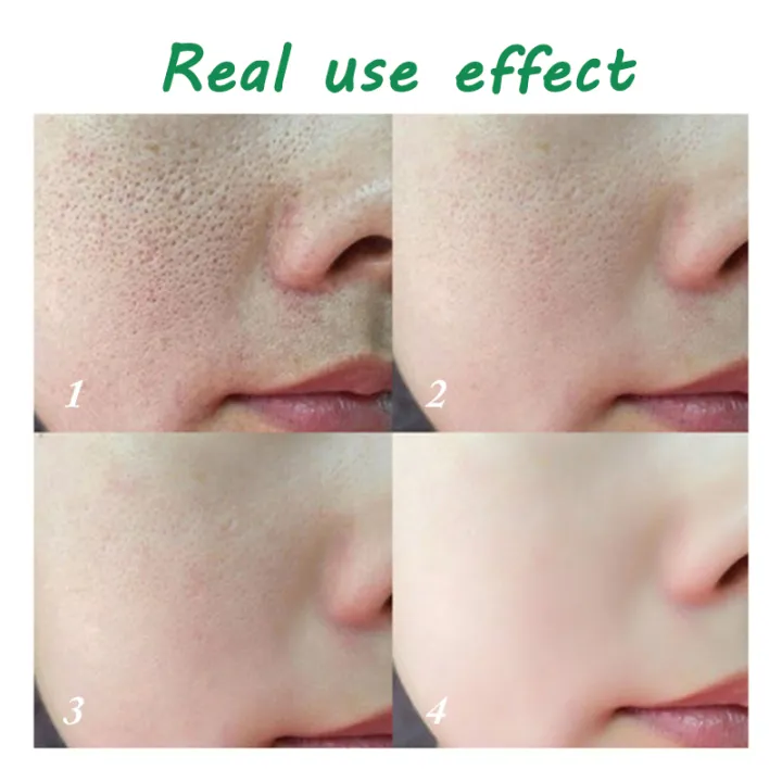 TopZ%20Tea%20Tree%20Acne%20Treatment%20Cream%20Pore%20Shrink%20Oil%20Control%20Whitening%20Repair%20Pimple%20Deep%20Cleaning%20Anti%20acne%20Moisturizer%20Face%20Skin%20Care%20phone%20case%20-%20Image%203