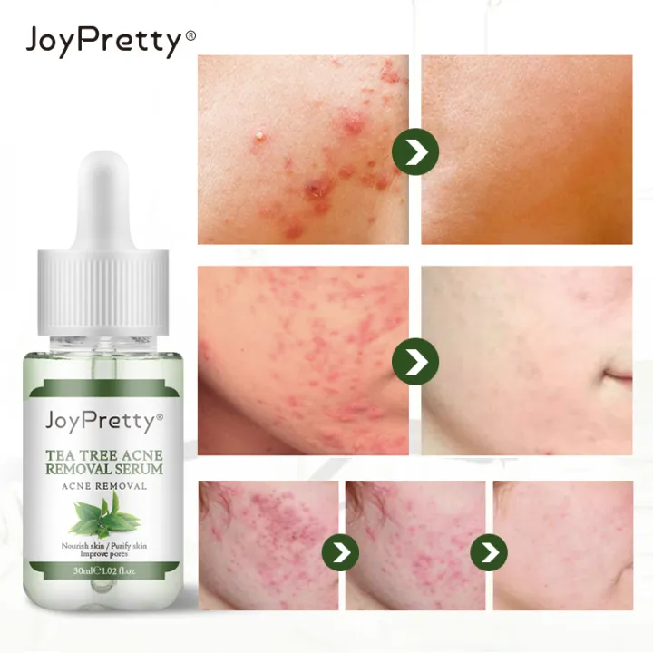 Joypretty%206pcs%20Face%20Skin%20Care%20Set%20Tea%20Tree%20Extract%20Acne%20Removal%20Improve%20Pores%20Face%20Cream%20Cleanser%20Repair%20Korean%20Cosmetics%20Kit%20-%20Facial%20Care%20Sets%20&%20Kits%20-%20AliExpress%20-%20Image%206
