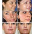 Melasma Remover Cream Removal Dark Pigment Brighten Cream Face Fade Dull Skin Cream Nicotinamide Brightening Moisturize Emulsion. 