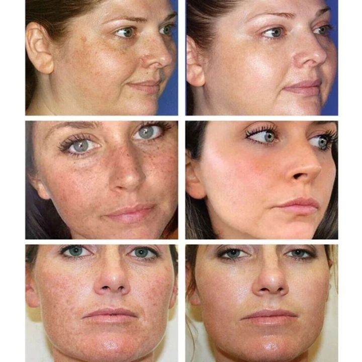 Melasma%20Remover%20Cream%20Removal%20Dark%20Pigment%20Brighten%20Cream%20Face%20Fade%20Dull%20Skin%20Cream%20Nicotinamide%20Brightening%20Moisturize%20Emulsion%20-%20Image%207