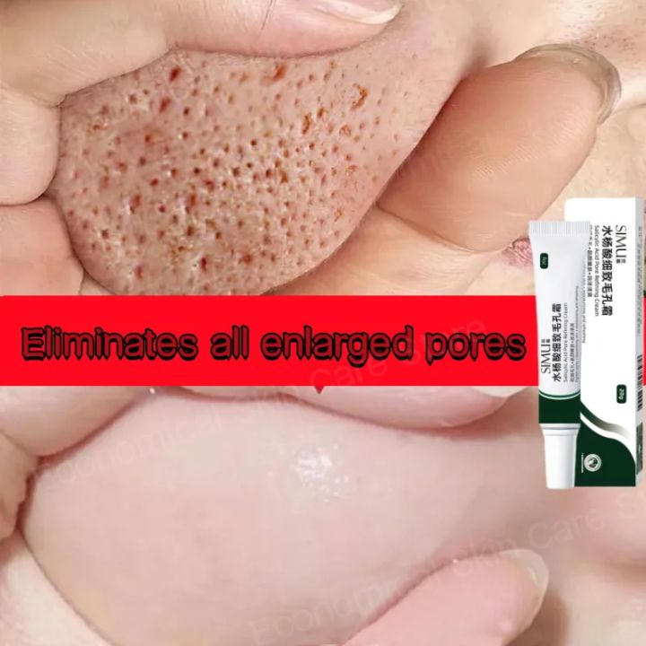 Salicylic%20Acid%20Pores%20Shrink%20Refining%20Cream%20Treatments%20Large%20Open%20Pore%20Remove%20Black%20Dots%20Blackhead%20Acne%20Marks%20Face%20Skin%20Products%20-%20Image%203