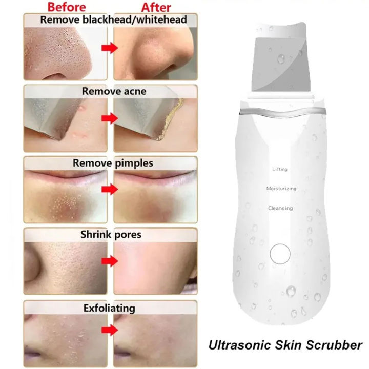 Ultrasonic%20Skin%20Scrubber%20Peeling%20Blackhead%20Remover%20Deep%20Face%20Cleaning%20Skin%20Scrubber%20Acne%20Pore%20Cleaner%20Facial%20Shovel%20Cleanser%20-%20Image%204