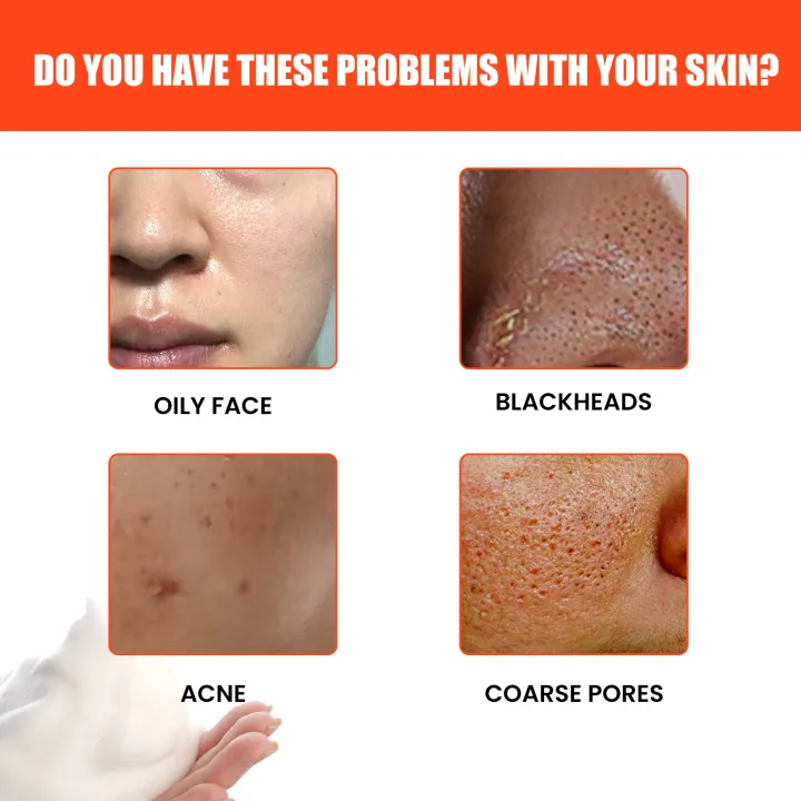 Men%20Facial%20Cleanser%20Wash%20Deep%20Facial%20Cleansing%20Remove%20Acne%20Blackhead%20Shrink%20Pores%20Oil%20Control%20Moisturizing%20Exfoliating%20Skin%20Care%20-%20Image%203