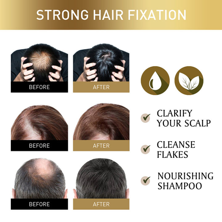 TopZ%20Fast%20Anti%20Dandruff%20Hair%20Oil%20Control%20Treatment%20Relieve%20Itching%20Repair%20Scalp%20Cleaning%20Exfoliating%20Products%20Antipruritic%20Hair%20Care%20Phone%20case%20-%20Image%207