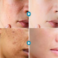 Salicylic Acid Pores Shrink Refining Cream Treatments Large Open Pore Remove Black Dots Blackhead Acne Marks Face Skin Products.