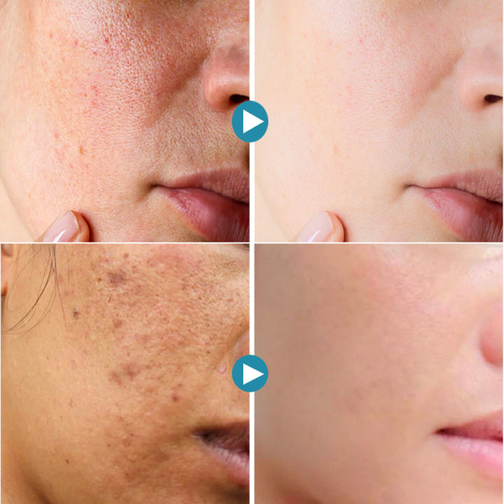 Salicylic%20Acid%20Pores%20Shrink%20Refining%20Cream%20Treatments%20Large%20Open%20Pore%20Remove%20Black%20Dots%20Blackhead%20Acne%20Marks%20Face%20Skin%20Products%20-%20Image%204