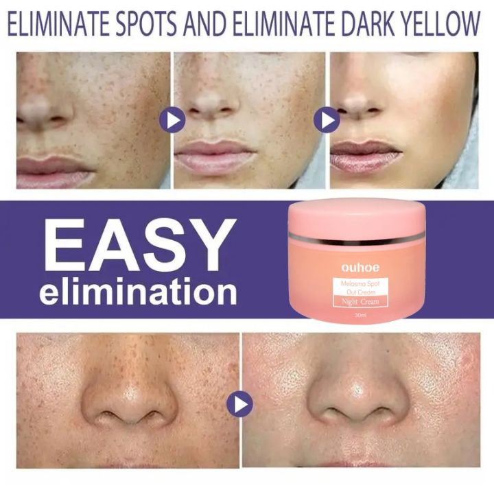 Melasma%20Remover%20Cream%20Removal%20Dark%20Pigment%20Brighten%20Cream%20Face%20Fade%20Dull%20Skin%20Cream%20Nicotinamide%20Brightening%20Moisturize%20Emulsion%20-%20Image%206