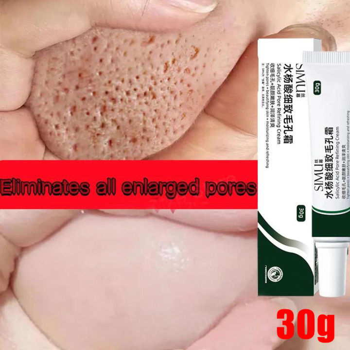 Swanwany Salicylic Acid Pores Shrink Refining Cream Repair Large Open Pore Remove Black Dots Blackhead Acne Marks Face Skin Care Products phone case
