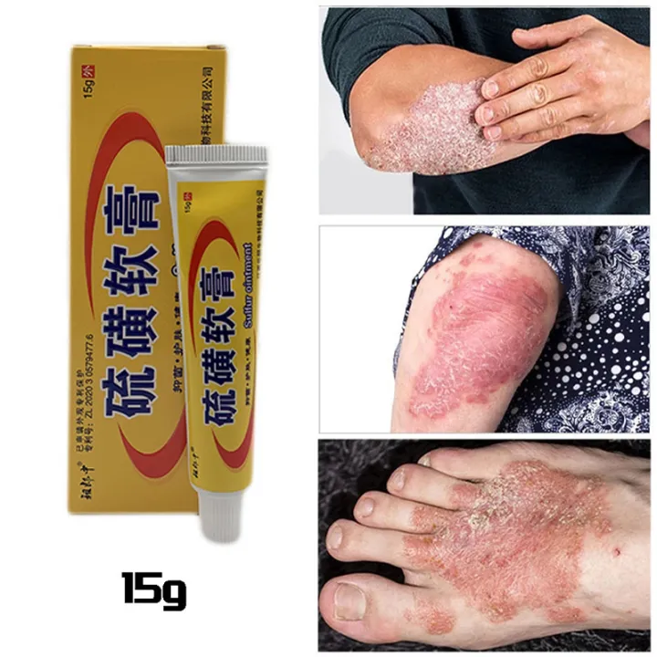 In%20blue%20In%20Sulfur%20Antibacterial%20Cream%20Soap%20Spray%20Set%20Psoriasis%20Eczema%20Anti%20itch%20Relief%20Rash%20Urticaria%20Desquamation%20Ointment%20Body%20Skin%20Care%20phone%20case%20-%20Image%204