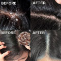 TopZ Fast Anti Dandruff Hair Oil Control Treatment Relieve Itching Repair Scalp Cleaning Exfoliating Products Antipruritic Hair Care Phone case. 