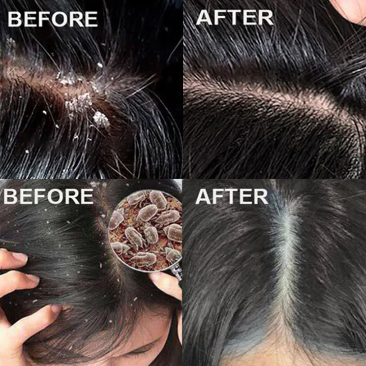 TopZ%20Fast%20Anti%20Dandruff%20Hair%20Oil%20Control%20Treatment%20Relieve%20Itching%20Repair%20Scalp%20Cleaning%20Exfoliating%20Products%20Antipruritic%20Hair%20Care%20Phone%20case%20-%20Image%203