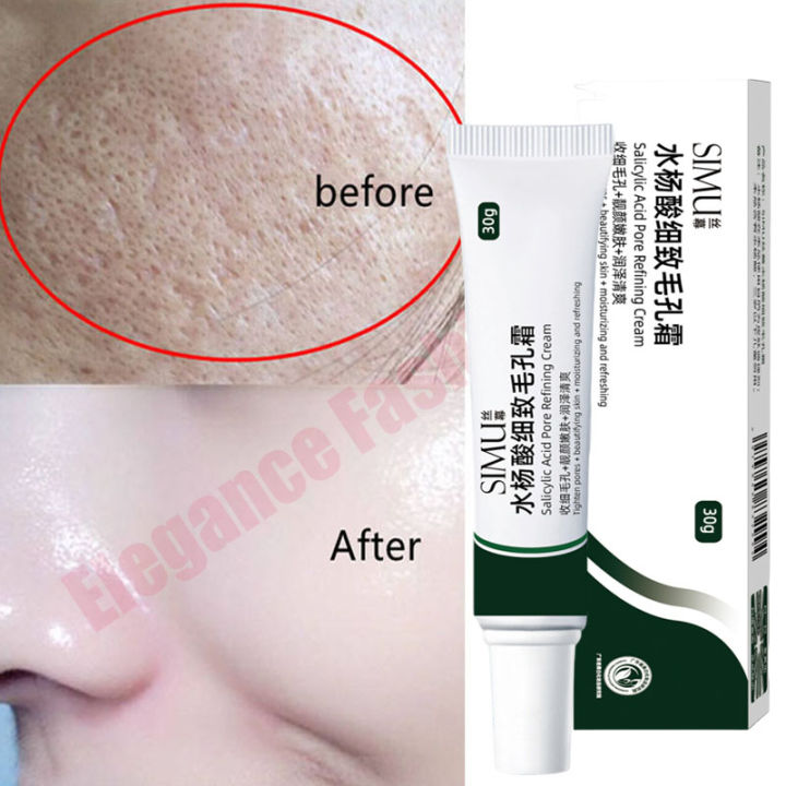 Salicylic Acid Pores Shrink Refining Cream Treatments Large Open Pore Remove Black Dots Blackhead Acne Marks Face Skin Products