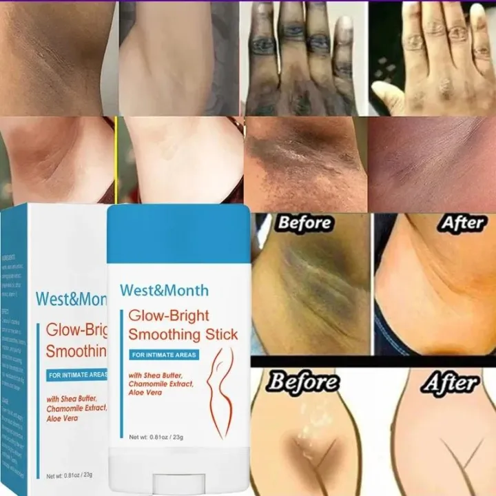 MoupBoi%20Whitening%20Cream%20Private%20Parts%20Bleaching%20Serum%20Lightening%20Underarm%20Dark%20Spot%20Brightening%20Stick%20Armpit%20Legs%20Knees%20Body%20Skin%20Care%20Phone%20Case%20-%20Image%202