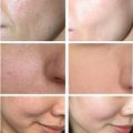 Swanwany Salicylic Acid Pores Shrink Refining Cream Repair Large Open Pore Remove Black Dots Blackhead Acne Marks Face Skin Care Products phone case.