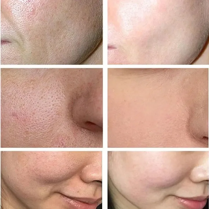 Swanwany%20Salicylic%20Acid%20Pores%20Shrink%20Refining%20Cream%20Repair%20Large%20Open%20Pore%20Remove%20Black%20Dots%20Blackhead%20Acne%20Marks%20Face%20Skin%20Care%20Products%20phone%20case%20-%20Image%205