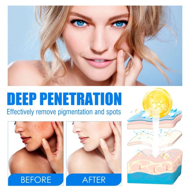 Melasma%20Remover%20Cream%20Removal%20Dark%20Pigment%20Brighten%20Cream%20Face%20Fade%20Dull%20Skin%20Cream%20Nicotinamide%20Brightening%20Moisturize%20Emulsion%20-%20Image%204
