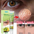 autistictic Fat Granules Remover Eye Cream Effective Remove Fat Granules Puffiness Anti Particles Milia Remover Product Repair Eye Skin Care phone case. 
