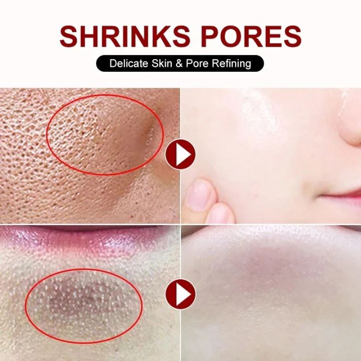 MoupBoi%20Salicylic%20Acid%20Shrink%20Pore%20Cream%20Elimination%20Large%20Pores%20Quick%20Remove%20Blackehead%20Tighten%20Face%20Smooth%20Repairing%20Skin%20Care%20Product%20Phone%20case%20-%20Image%207