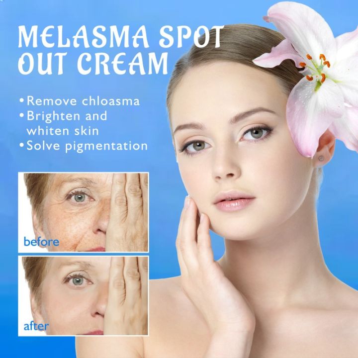 Melasma%20Remover%20Cream%20Removal%20Dark%20Pigment%20Brighten%20Cream%20Face%20Fade%20Dull%20Skin%20Cream%20Nicotinamide%20Brightening%20Moisturize%20Emulsion%20-%20Image%203