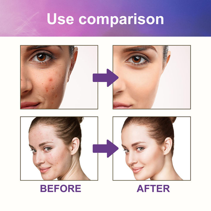 Gesh%20Sanrio%20Hello%20Kitty%20Acne%20Pimple%20Patch%20Sticker%20Acne%20Pimple%20Remover%20Tool%20Blemish%20Spot%20Facial%20Mask%20Skin%20Care%20Cartoon%20Hidden%20Pimple%20phone%20case%20-%20Image%207