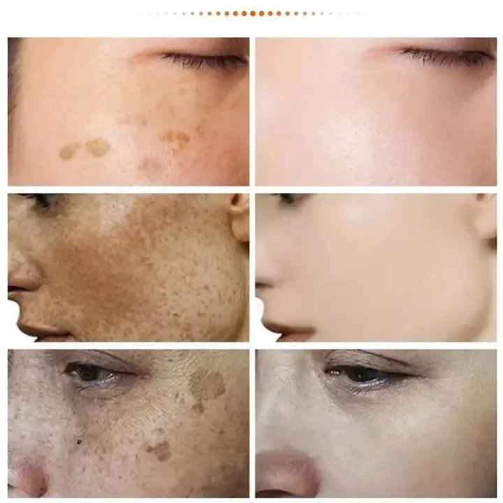 Swanwany%20eelhoe%20Niacinamide%20Melasma%20Brightening%20Cream%20Reduce%20Melanin%20Brighten%20Cream%20Lighten%20Dark%20Skin%20Chloasma%20Serum%20Fade%20Fine%20Face%20Lines%20phone%20case%20-%20Image%203
