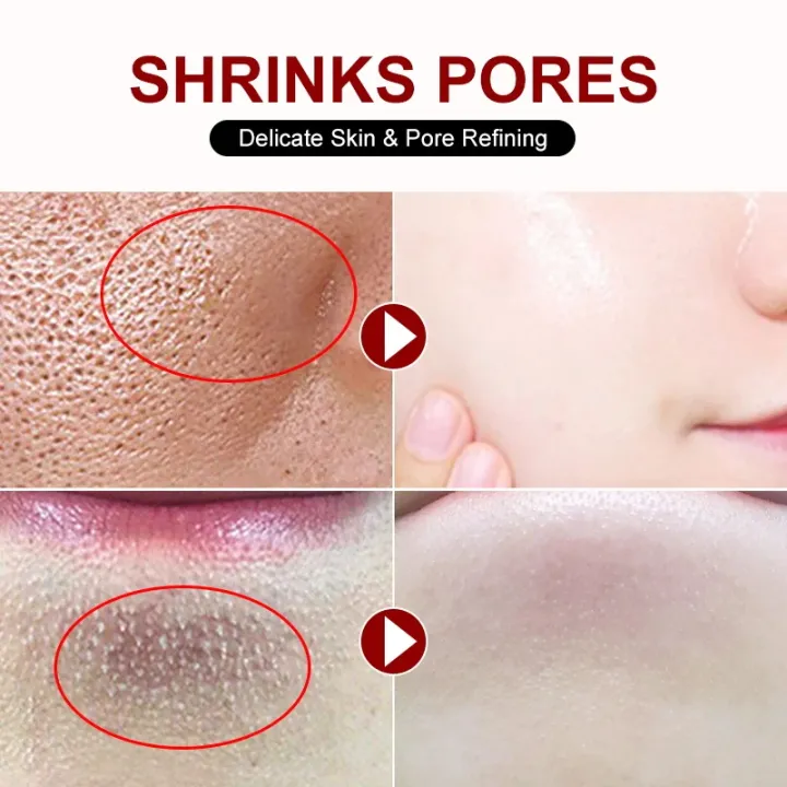 Salicylic%20Acid%20Pore%20Shrinking%20Cream%20Quick%20Elimination%20Large%20Pores%20Remove%20Blackehead%20Tighten%20Face%20Smooth%20Skin%20Korean%20Care%20Product%20-%20Image%203