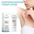Acanthosis Nigricans Therapy Cream Lighten Melanin Brighten Private Parts Dark Neck Elbow Armpits Moisturizing Body Care Lotion. 