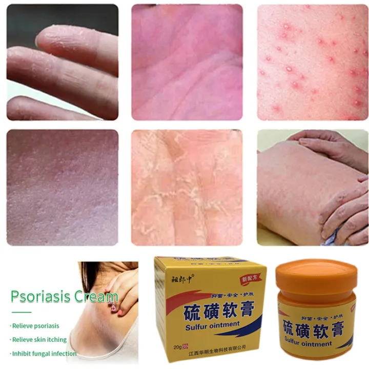 In%20blue%20In%20Sulfur%20Antibacterial%20Cream%20Soap%20Spray%20Set%20Psoriasis%20Eczema%20Anti%20itch%20Relief%20Rash%20Urticaria%20Desquamation%20Ointment%20Body%20Skin%20Care%20phone%20case%20-%20Image%205